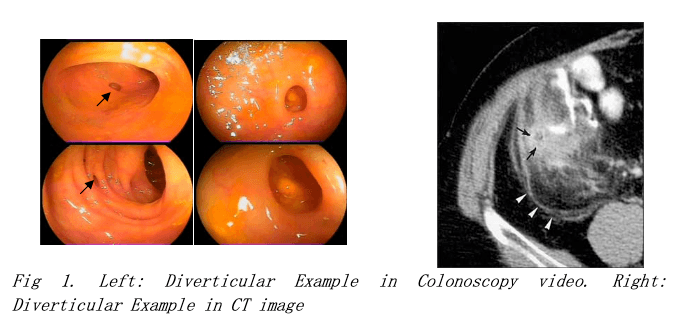 Diverticulosis detection system overview diagram