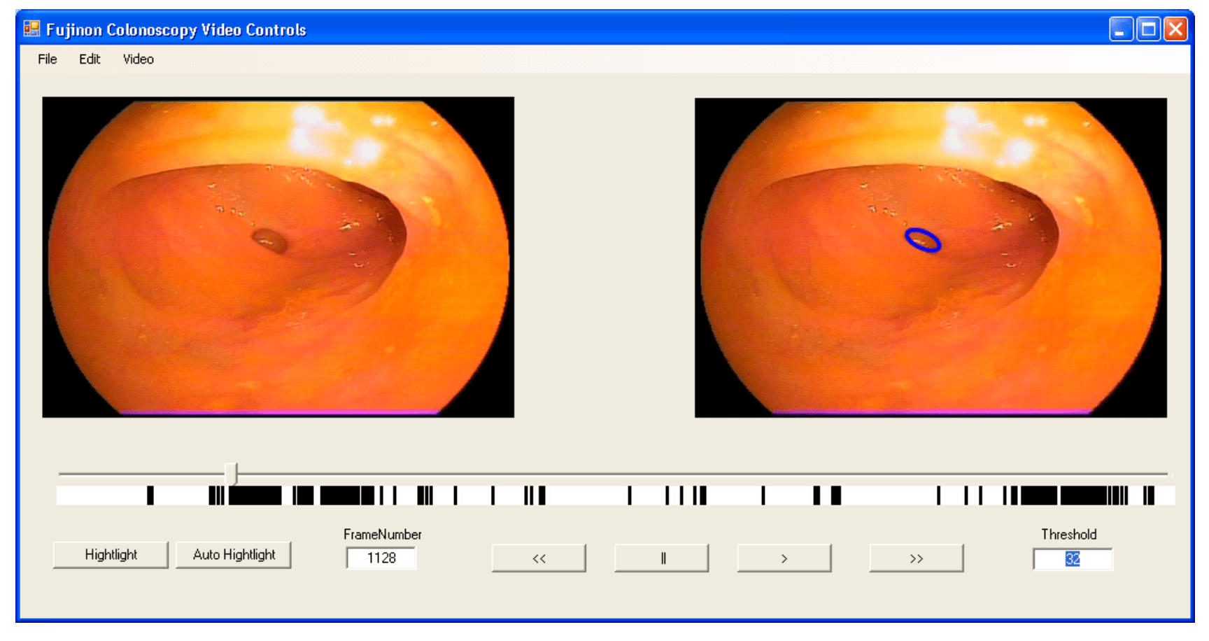 Diverticulosis detection interface showing side-by-side video frames